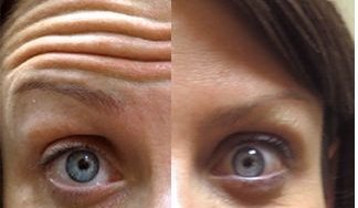botox behandeling voorhoofdsrimmpels botox voorhoofdsrimpels den haag