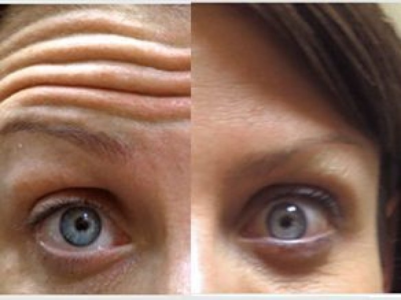 voorhoofdsrimpels den haag botox voorhoofdsrimpels behandeling den haag