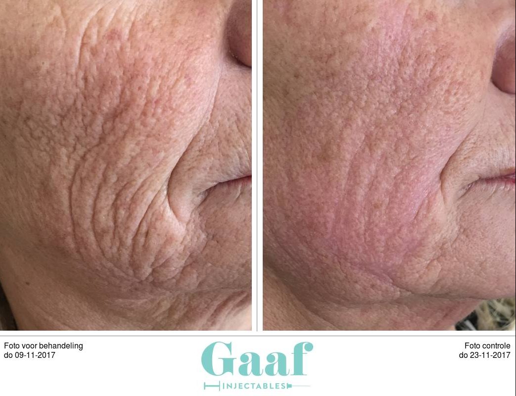 rimpels definitief verwijderen met Plexr plexr Den haag peelings den haag botox den haag fillers den haag skinboosters den haag dermapen den haag microneedling den haag