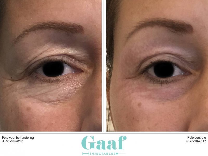 Plexr den haag ooglidcorrectie ooglift plexr den haag ooglidcorrectie plexr soft surgery plexr ervaringen plexr voor en nadelen plexr wallen