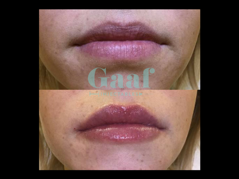 lippen opvullen den haag volle lippen dikke lippen botox lippen lipfillers lipvergroting hyaluronzuur fillers den haag
