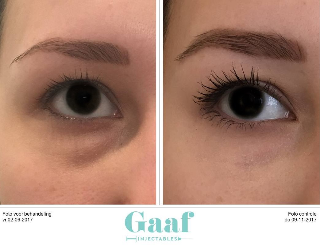 Donkere kringen wegwerken met fillers