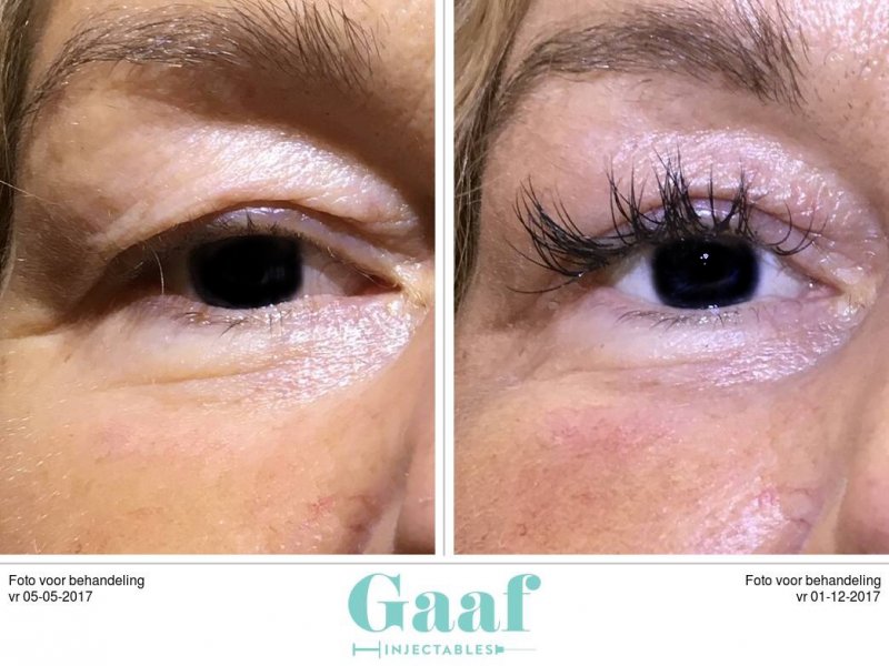 plexr den haag ooglidcorrectie plexr soft surgery plexr ervaringen plexr voor en nadelen plexr wallen