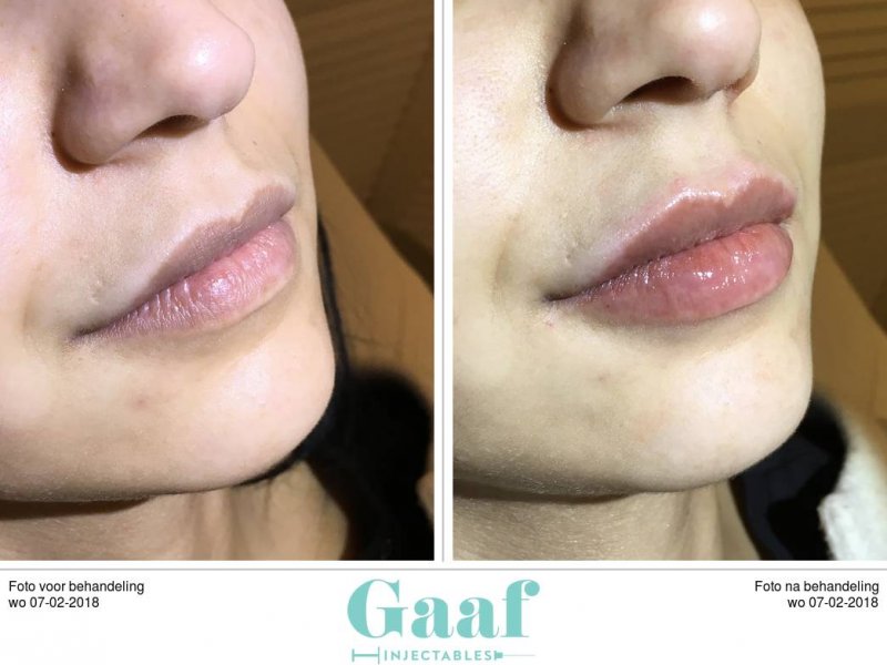 lippen opvullen den haag volle lippen dikke lippen botox lippen lipfillers lipvergroting hyaluronzuur fillers den haag
