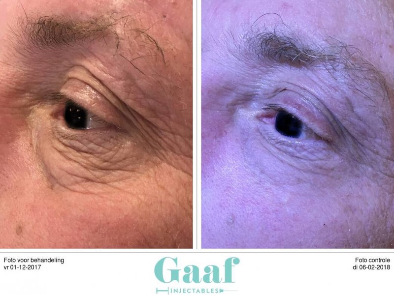 Plexr den haag kraaienpootjes ooglift kraaienpootjes ooglift plexr den haag ooglidcorrectie plexr soft surgery plexr ervaringen plexr voor en nadelen plexr wallen