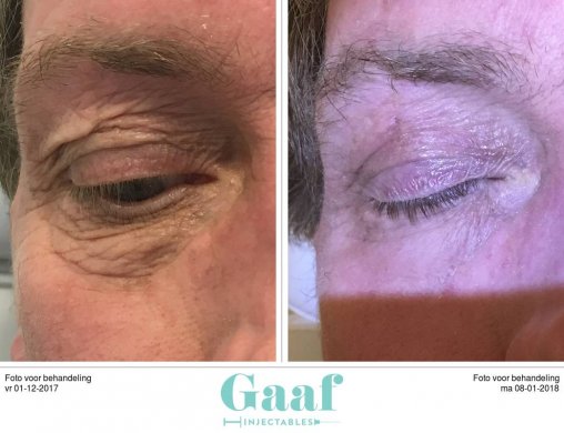 plexr den haag ooglidcorrectie plexr soft surgery plexr ervaringen plexr voor en nadelen plexr wallen