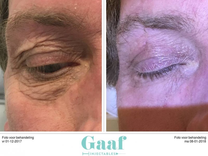 ooglidcorrectie plexr ooglidcorrectie en botoxbehandelingen