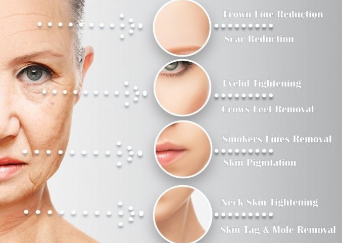 plexr den haag ooglidcorrectie plexr soft surgery plexr ervaringen plexr voor en nadelen plexr wallen