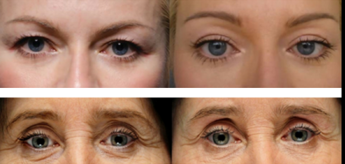 Voor en na foto van ooglidcorrectie met Plexr ooglidcorrectie plexr den haag