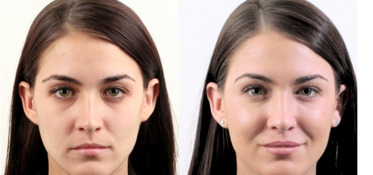 wangen opvullen met fillers fillers den haag wangen opvullen den haag