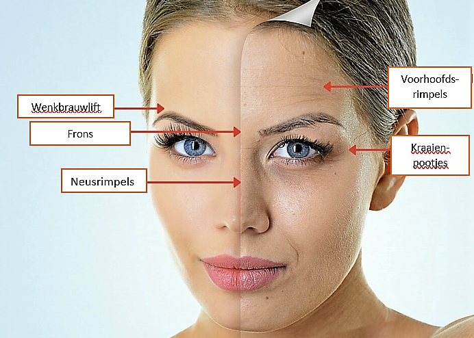 botox behandelgebieden botox den haag