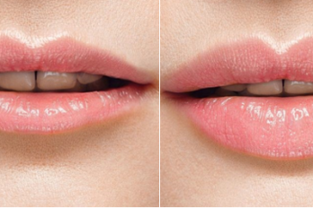 fillers den haag liquid facelift Fillers Den Haag, lippen opvullen Den Haag, fillers in lip, volle lippen den haag, botox lippen den haag, lipvergroting den haag, wangen opvullen, hyaluronzuur, neus lippen plooi opvullen marionetlijnen opvullen filler donkere kringen onder ogen wallen traangootjes