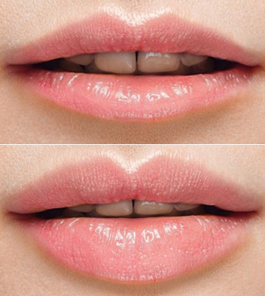 lippen vergroten met lipfillers lipfillers den haag fillers den haag lippen vergroten den haag