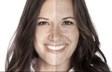 Huidveroudering  botox den haag fillers den haag plexr den haag