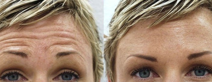 Voorhoofdsrimpels verwijderen met botox botox den haag fillers den haag plexr den haag