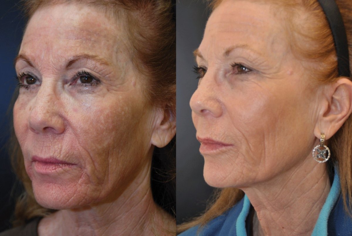 en rimpels ouderdomsvlekken verwijderen met een peeling peeling den haag, botox den haag plexr den haag fillers den haag dermapen den haag skinboosters den haag