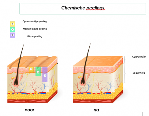 chemische peeling chemische peeling peelings den haag tca peeling den haag gezichts peeling