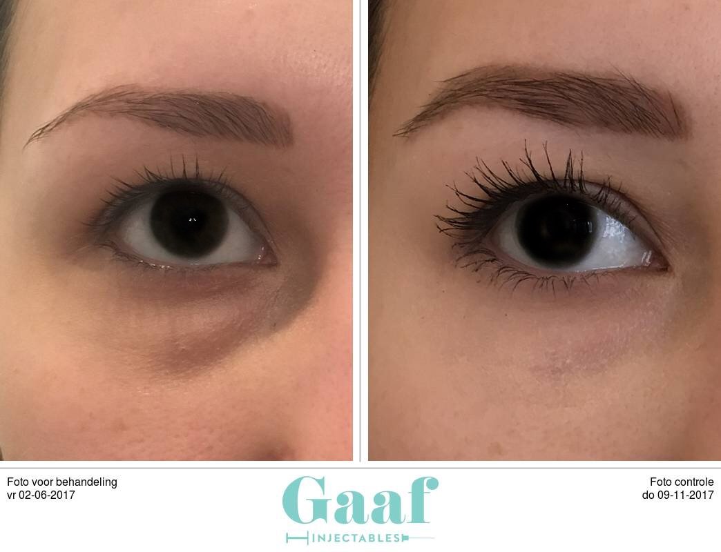 fillers behandeling wallen Fillers Den Haag, lippen opvullen Den Haag, fillers in lip, volle lippen den haag, botox lippen den haag, lipvergroting den haag, wangen opvullen,neus lippen plooi opvullen