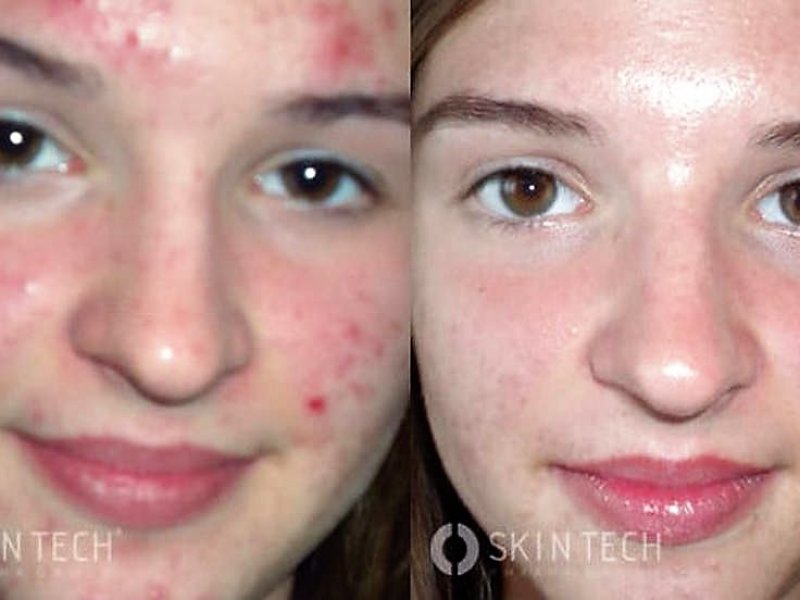 peelings den haag chemische peelings den haag tca peeling den haag gezichts peeling