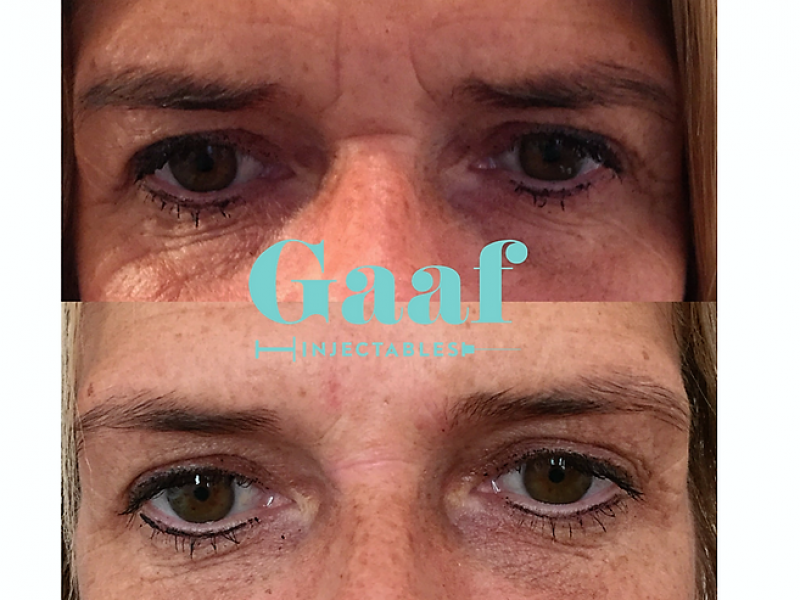 botox leiden botox rotterdam