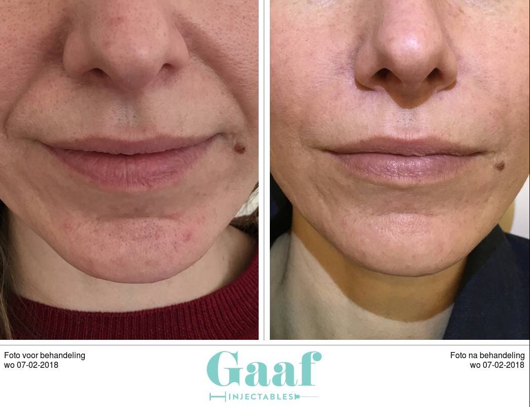 diepe neuslippenplooi gevuld met een filler dermapen den haag fillers den haag botox den haag peelings den haag skinboosters den haag plexr den haag