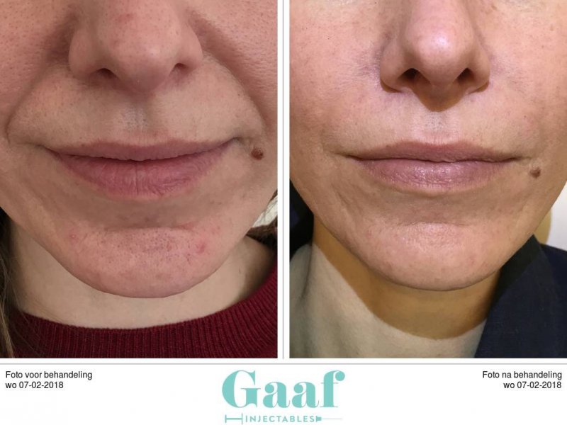 neus lippen plooi opvullen met fillers fillers neus lippen plooi den haag