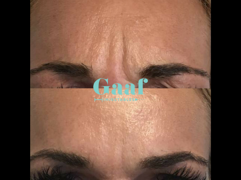 botox leiden botox rotterdam
