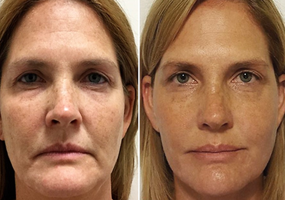 liquid facelift wangen opvullen fillers den haag