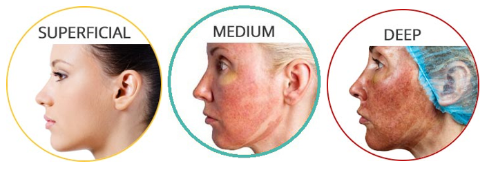 chemische peeling peelings den haag chemische peelings den haag tca peeling den haag gezichts peeling