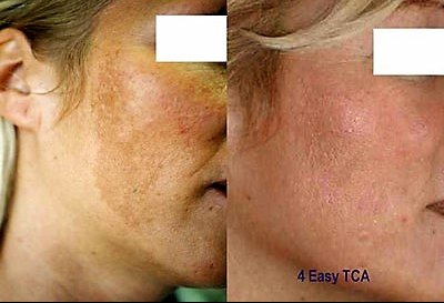 tca peeling tegen pigmentvlekken / ouderdomsvlekken peelings den haag tca peeling den haag