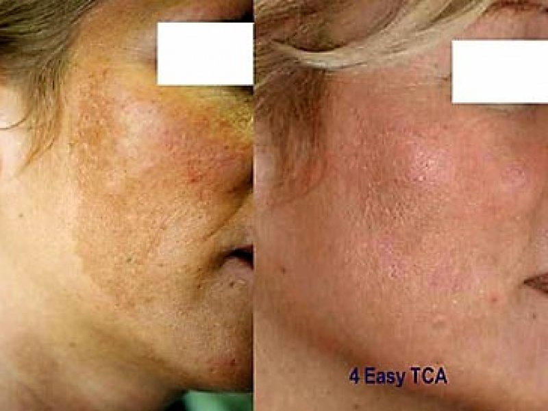 peelings den haag chemische peelings den haag tca peeling den haag gezichts peeling