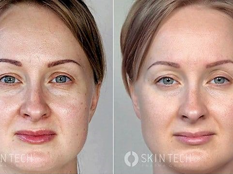 peelings den haag chemische peelings den haag tca peeling den haag gezichts peeling