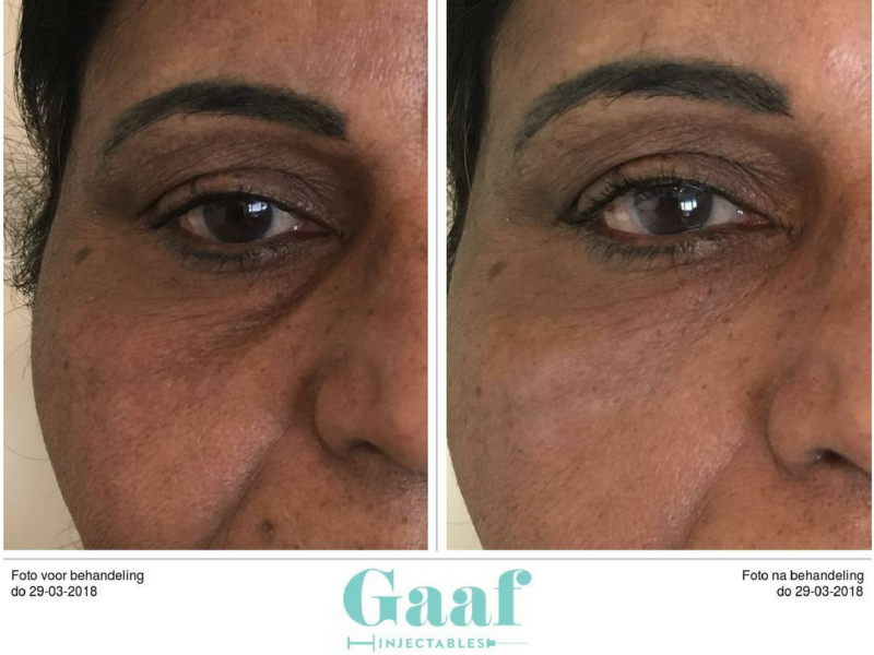 wallen verwijderen met fillers fillers wallen donkere kringen en botox wenkbrauwlift