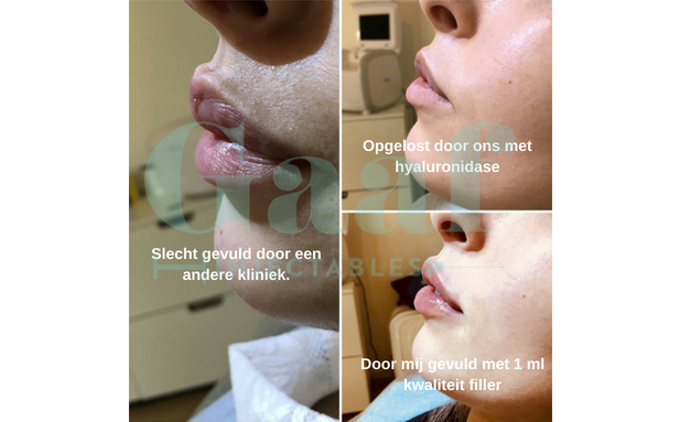 correctie lipfillers lippen opvullen fillers lippen den haag