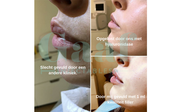 lippen opvullen fillers lippen den haag