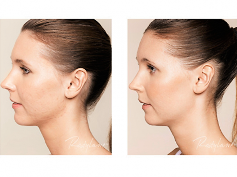 skinboosters voor en na foto's acne skinboosters den haag