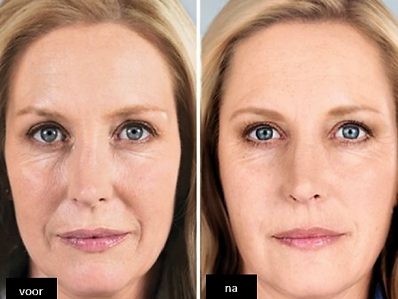 Profhilo voor en na foto's acne verwijderen