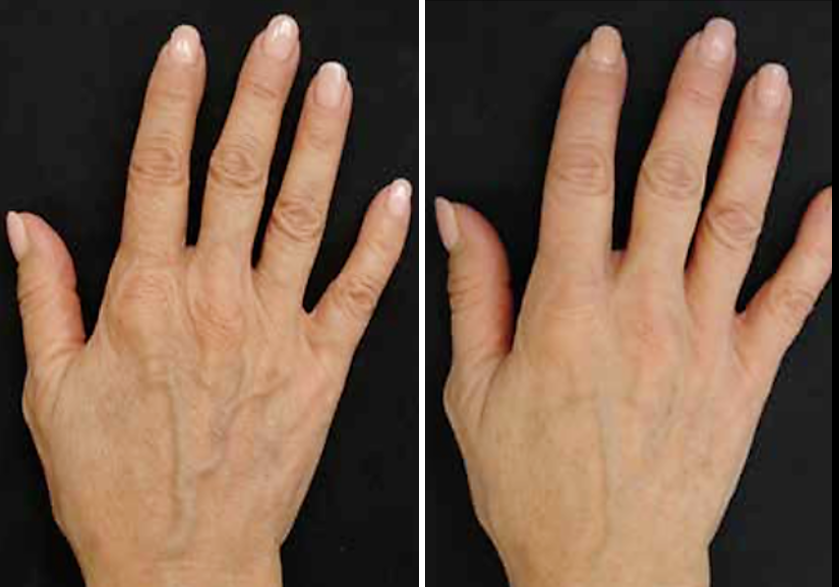 Profhilo behandeling voor handen Profhilo den haag