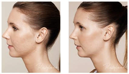 Behandeling voor twintigers