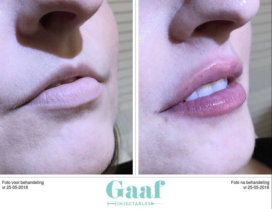 Lippen verfraaien met lipfillers