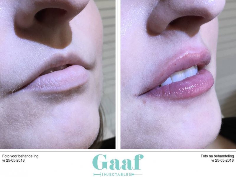 lipfillers behandeling den haag