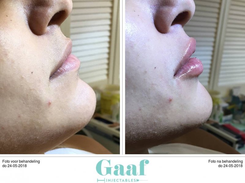lipfillers den haag