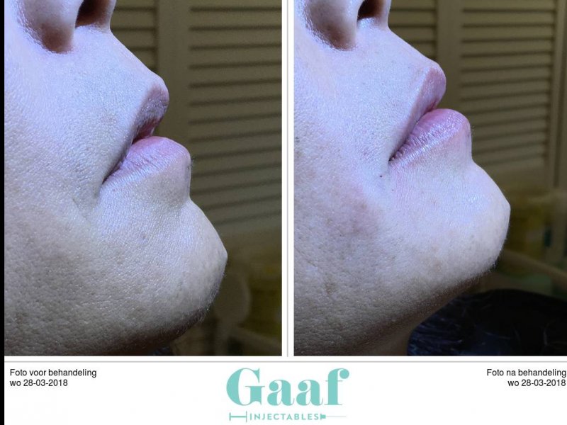 lippen opvullen den haag volle lippen dikke lippen botox lippen lipfillers lipvergroting hyaluronzuur fillers den haag