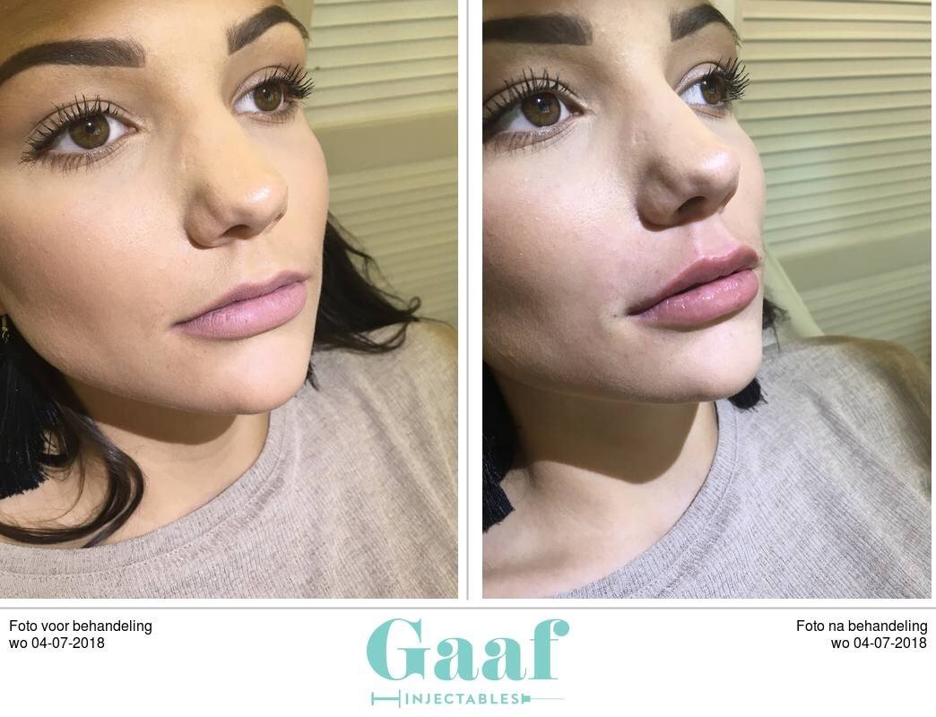 Lippen opvullen lippen opvullen den haag, lipfillers den haag