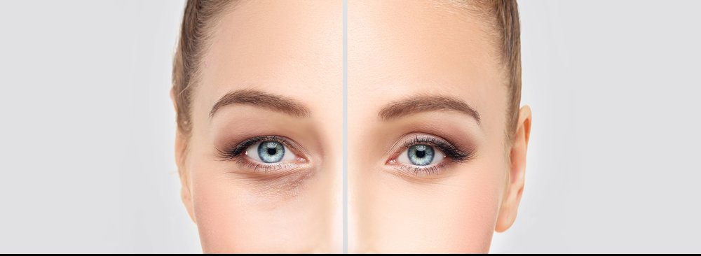 wallen en donkere kringen wallen wegwerken den haag