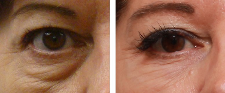 wallen wegwerken met fillers wallen wegwerken den haag fillers den haag botox den haag dermapen den haag plexr den haag microneedling den haag skinboosters den haag peeling den haag