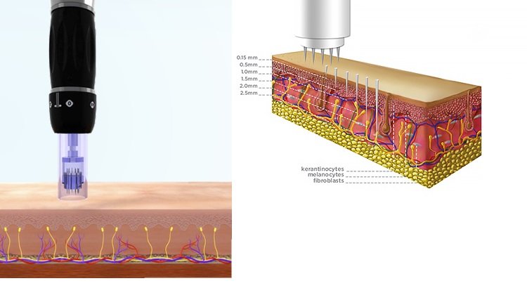 Dermapen werking Dermapen behandeling microneedling dermapen ervaringen dermapen voor en na dermapen kosten