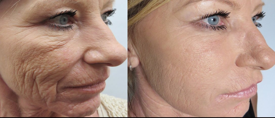 huidverbetering met dermapen dermapen den haag microneedling den haag botox dne haag fillers den haag plexr den haag peelings den haag skinboosters den haag