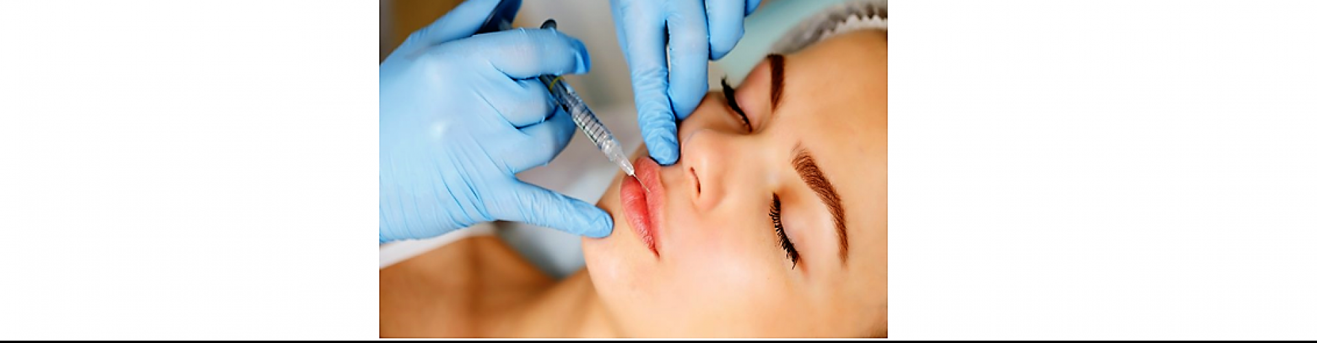 filler behandeling Fillers Den Haag, lippen opvullen Den Haag,