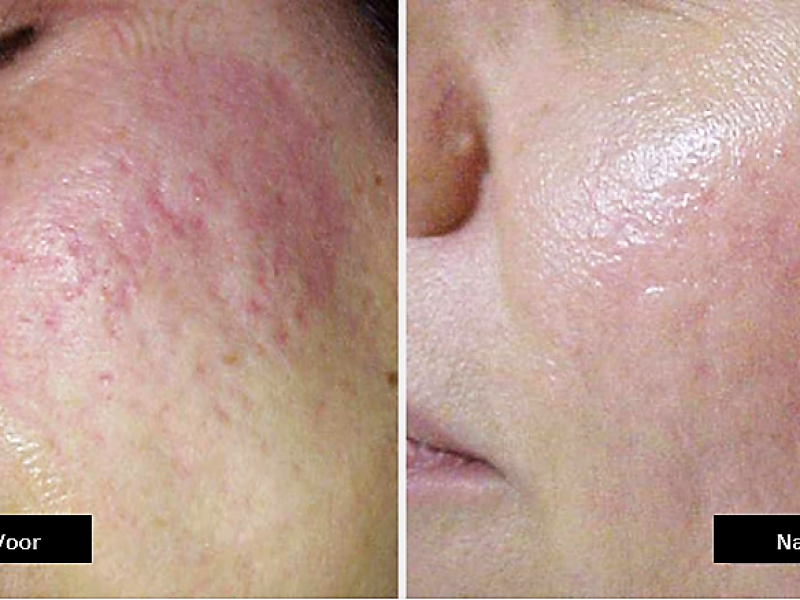 littekens verminderen met dermapen Dermapen behandeling microneedling dermapen ervaringen dermapen voor en na dermapen den haag